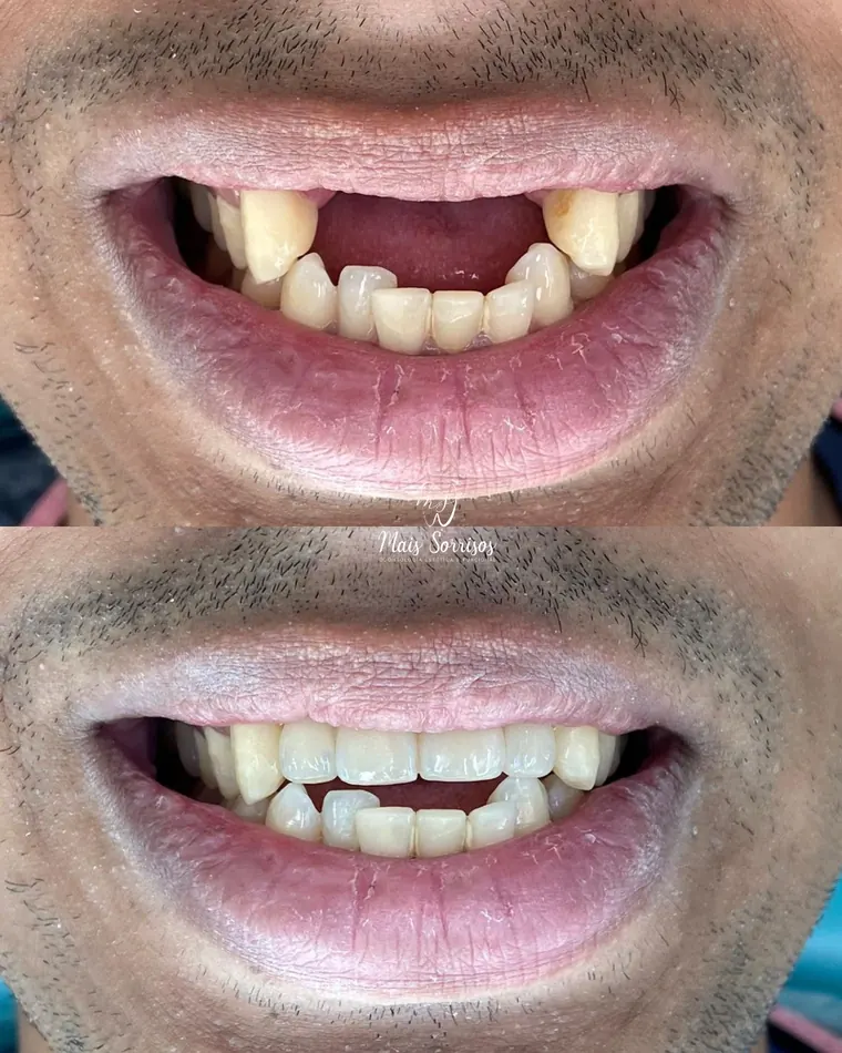 Antes e depois de implantes dentários nos dentes anteriores