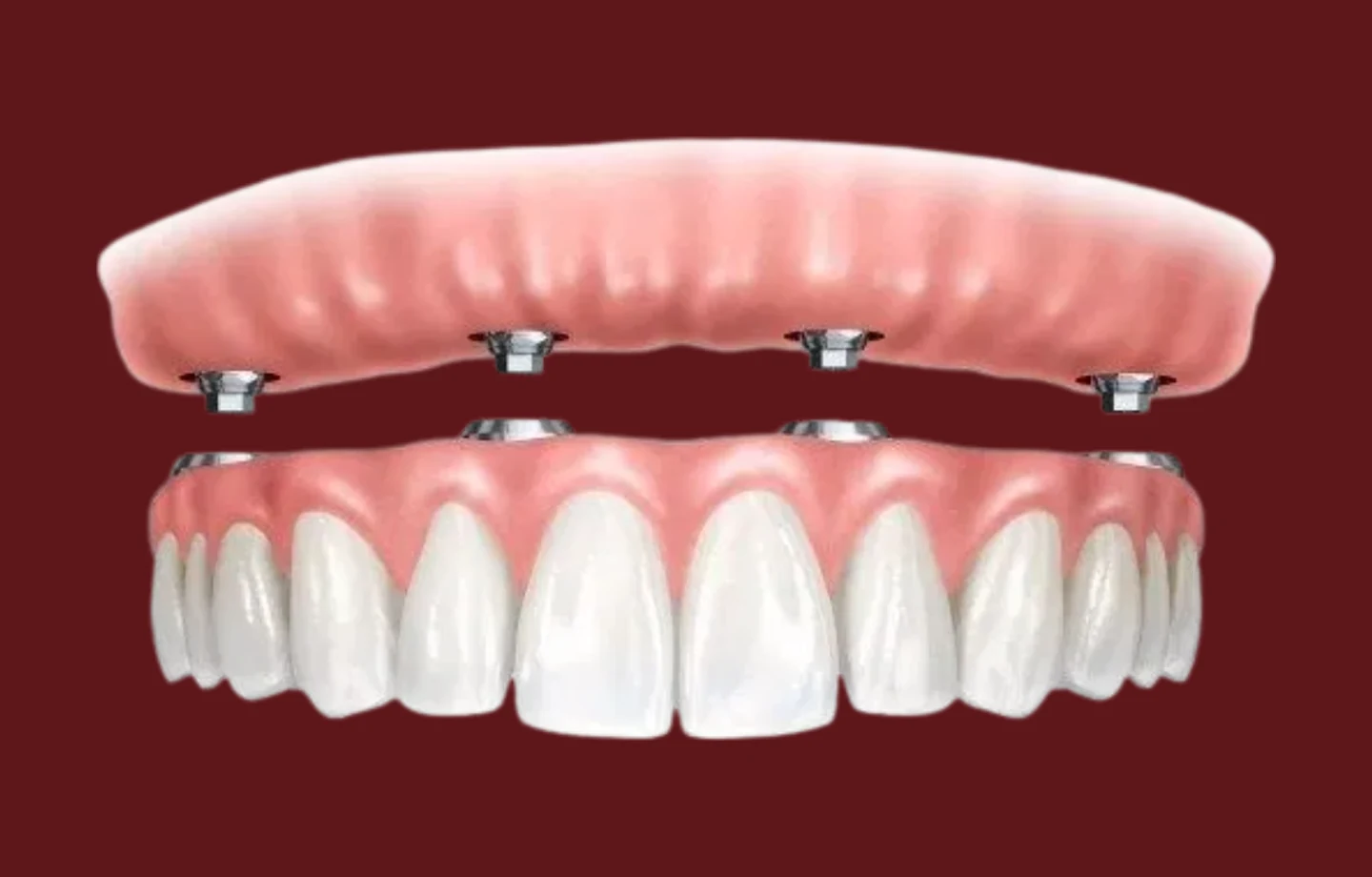 Ilustração de prótese protocolo: arcada fixa apoiada sobre quatro implantes